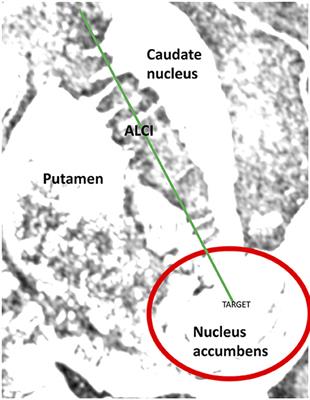 Treating Aggression and Self-destructive Behaviors by Stimulating the Nucleus Accumbens: A Case Series